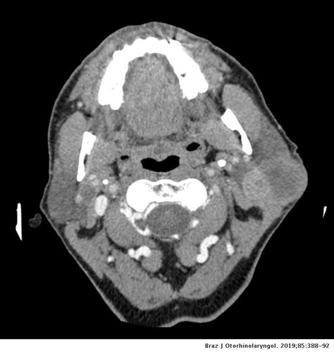 Parotid Gland Tumor Ultrasound