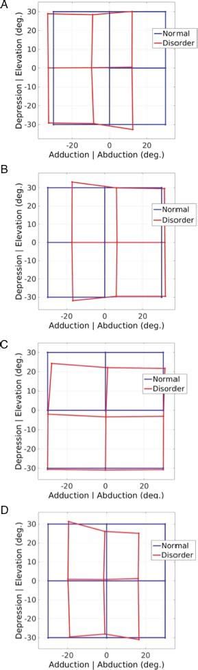 (A) Simulation of isolated medial rectus palsy. (B) Simulation of ...