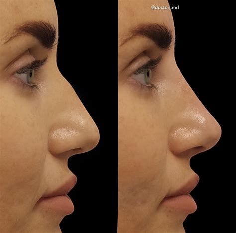 Non Surgical Rhinoplasty Procedures Vancouver One Clinic Md