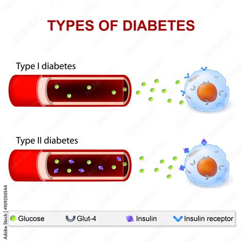 Types of Diabetes Stock Vector | Adobe Stock