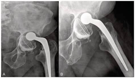 Preoperative Image Exams A Left Hip X Ray Demonstrating A Loose Download Scientific Diagram