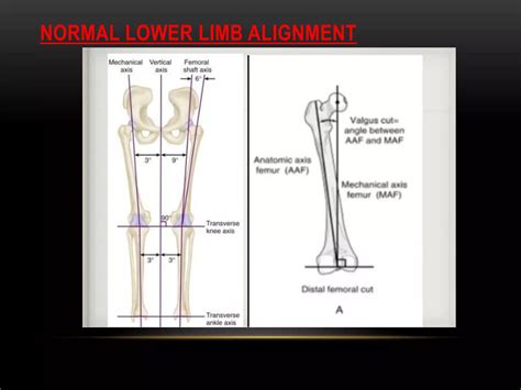 Genu varum valgus ,coxa varum | PPTX