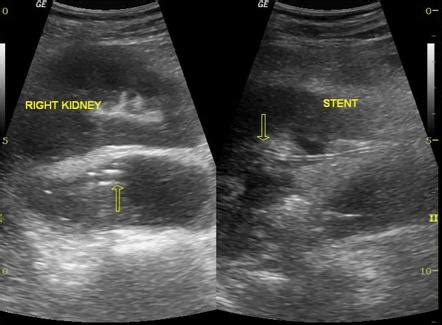 Perinephric Abscess Ultrasound