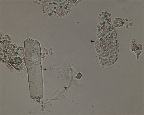 Urine casts | eClinpath