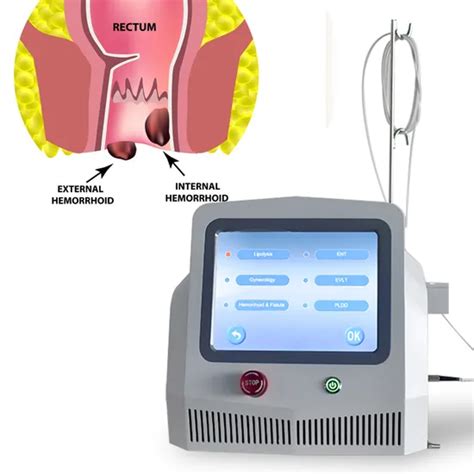 nm nm Hemorroides Fístula Anal Hemorroidectomía Dispositivo Láser Diode Hemorroides