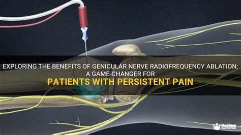 Exploring The Benefits Of Genicular Nerve Radiofrequency Ablation A