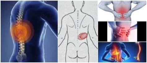 Dolor de Espalda Media Signos Síntomas Factores De Riesgo Causas