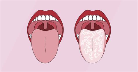 Oral Thrush Only On Tongue