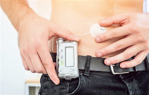 Что такое инсулиновая помпа для диабетиков? - Klinik.by