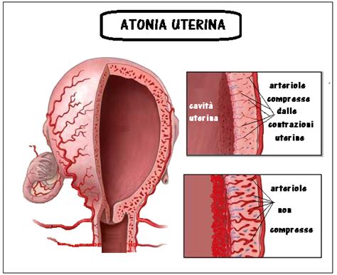 Atonia Uterina O Que É