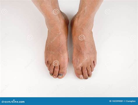 Subungual Hematoma On Index Finger Stock Image