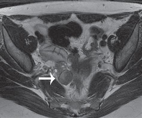 Endometrioma Axial Mri T Weighted Sequence Acquired With A T