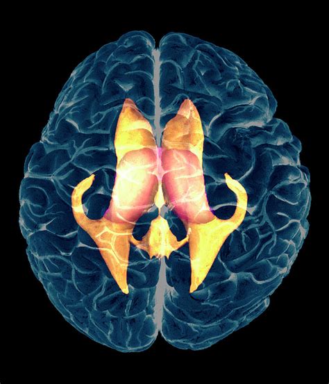 Ventricles Of Brain Photograph By Zephyr Science Photo Library Fine