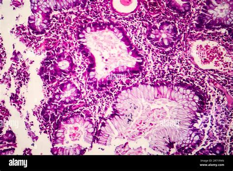 Villous Colon Adenocarcinoma Light Micrograph Photo Under Microscope