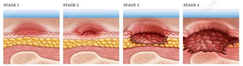 pressure ulcer stage