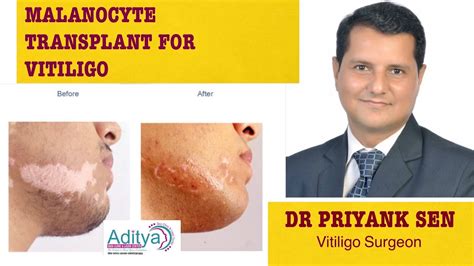 Melanocyte Transplant For Vitiligo By Dr Priyank Sen Youtube