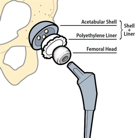 Schematic Diagram Of A Total Hip Replacement Indicating The Different Download Scientific