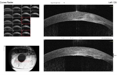 An Overview Of Anterior Segment Oct