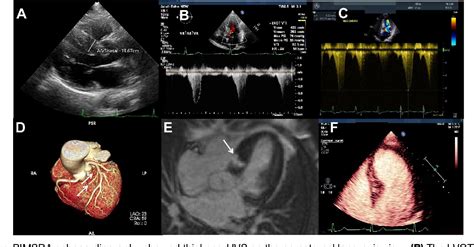 Figure 1 From Percutaneous Intramyocardial Septal Radiofrequency