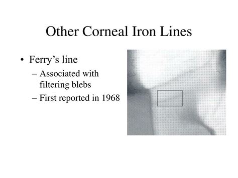 Ppt Corneal Iron Ring After Hyperopic Lasik Powerpoint Presentation