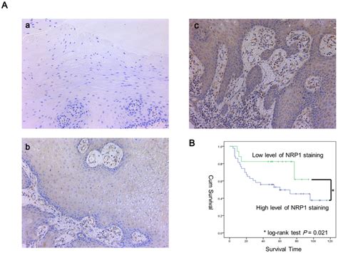 High Expression Of Nrp1 Correlates To Lymph Node Metastasis And Poor