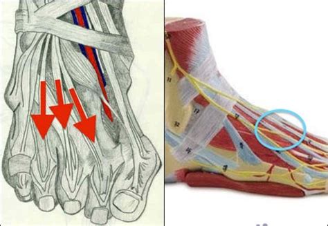 Guía completa para tratar las lesiones y tendinitis de los extensores