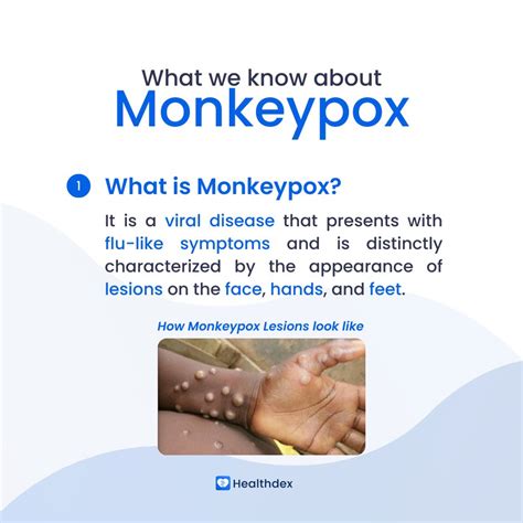 Healthdex On Twitter What Is Monkeypox Is This A New Virus How Does