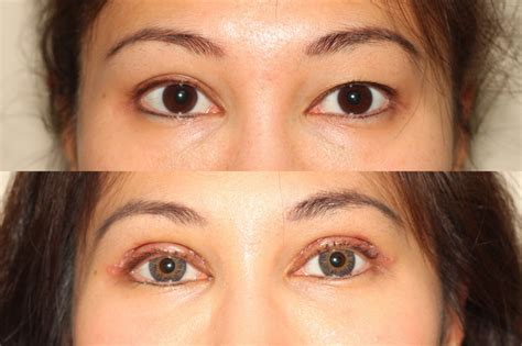 Asian Eyelid Surgery - Creating a Double Eyelid