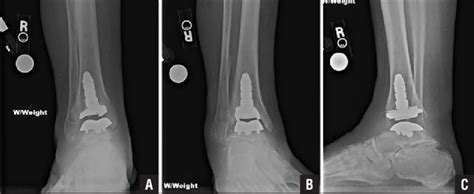 Weight Bearing Anteroposterior A Mortise B And Lateral C