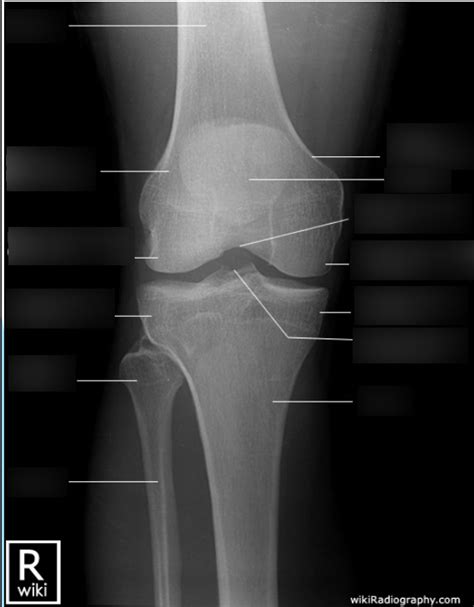 Knee Ap Lateral Labeling Diagram Quizlet