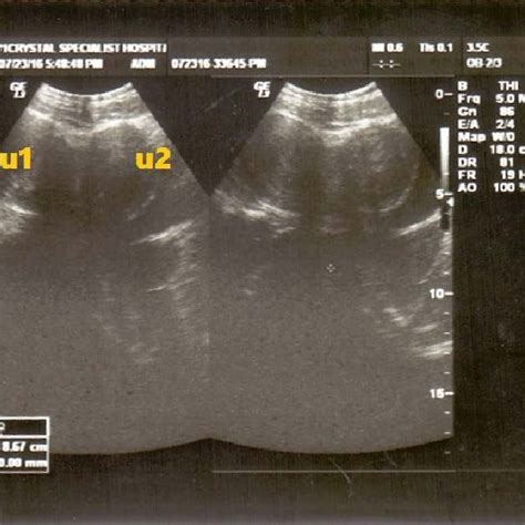 Control/normal longitudinal section of a non-gravid anteverted uterus... | Download Scientific ...