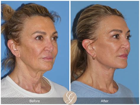 Deep Plane Facelifts Before & After Photos From Dr. Kevin Sadati