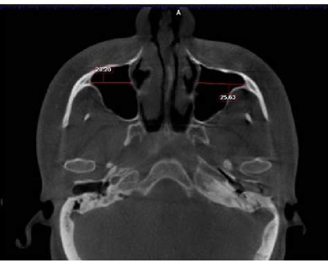 Figure 1 From The Role Of Cone Beam Computed Tomography In Sex