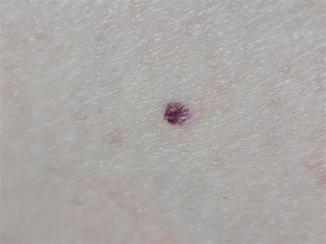 how to remove a cherry angioma 6