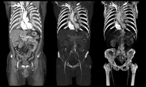 What is a Full Body CT scan? | Two Views