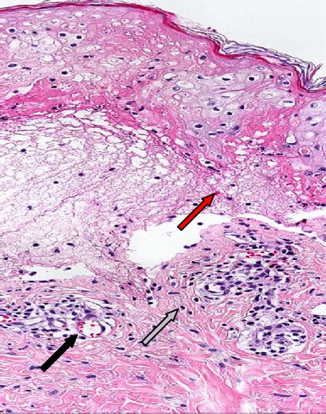 Histology Of Erythema Exudativum Multiforme Eem Staining Of An Eem