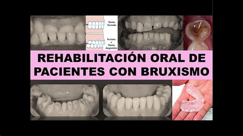 REHABILITACION ORAL DE PACIENTES CON BRUXISMO YouTube