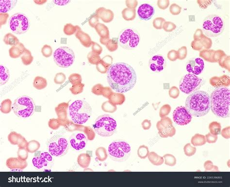 Leukemia Peripheral Blood Smear Patient Diagnosed Stock Photo ...