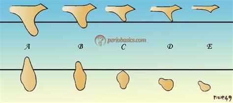 bone considerations  dental implant therapy periobasicscom