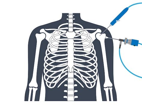 Premium Vector Shoulder Arthroscopy Procedure Rotator Cuff Tears Or Shoulder Impingement