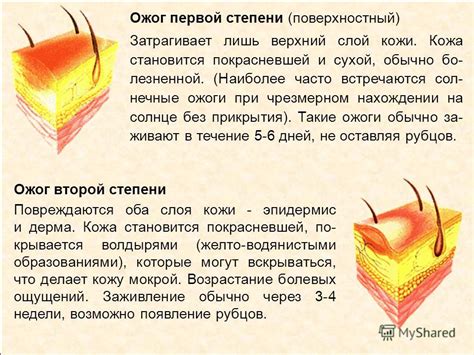 Презентация на тему: "ПЕРВАЯ МЕДИЦИНСКАЯ ПОМОЩЬ ПРИ ОЖОГАХ И ...