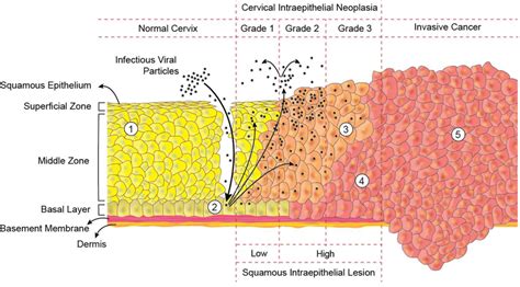 Pathology Dysplasia Carcinoma In Situ And Squamous Cell Carcinoma Of The Cervix Kembara Xtra