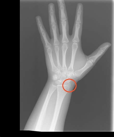 Why does my wrist crack. Wrist Cracking and Popping: Understanding