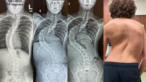 canadian kids spinal surgery waits  exceed recommendations