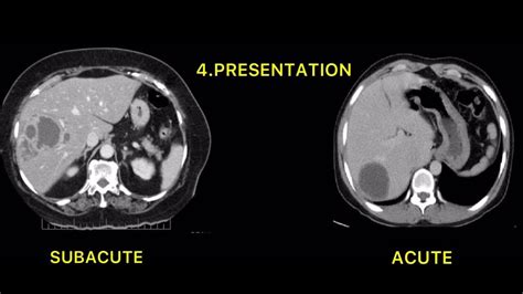 Amoebic Vs Pyogenic Liver Abscess Youtube