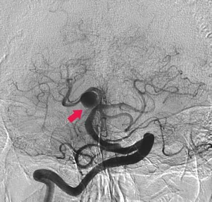 Aneurisma Cerebral