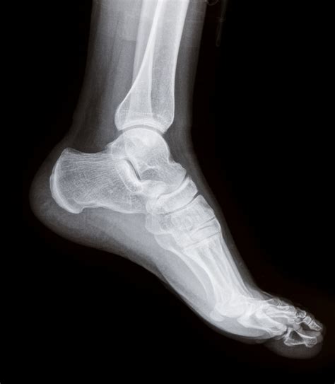 ANKLE FRACTURE 1 | Buyxraysonline