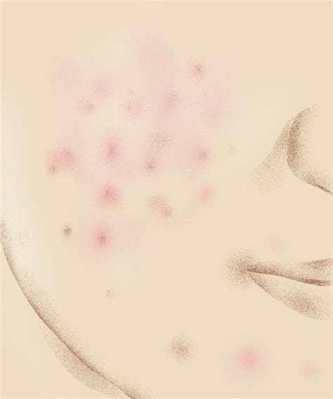 Pink Dots On Skin