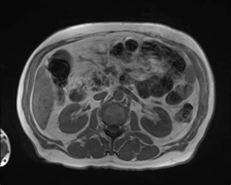 Pancreatic Duct Stone Image