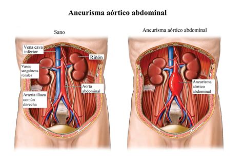 Aneurisma De Aorta Abdominal Ascendente Tor Cica S Ntomas